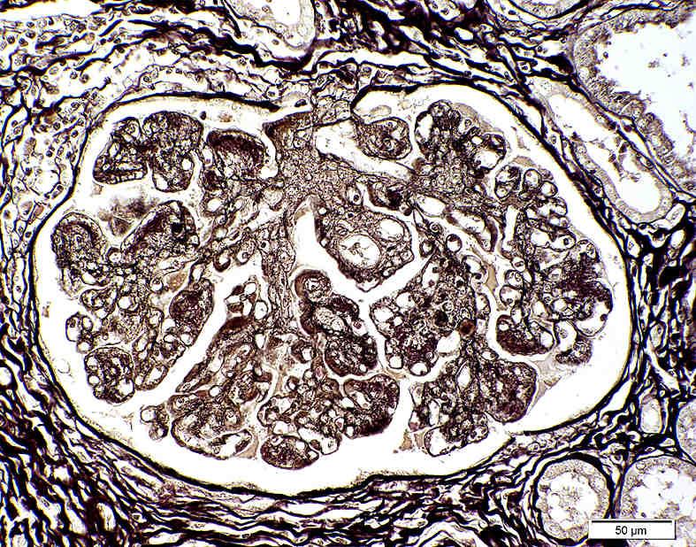 Verdopplung der kapillären Basalmembran ( ); Nierenkörperchen (N); Nierentubuli (T)