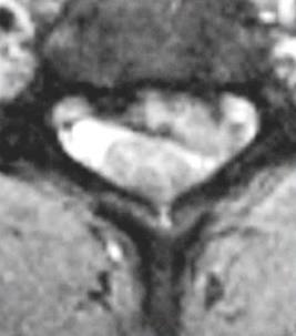 Suche untere Armplexusläsion (C8-Th1), +/- inkompletter Paresegrad 1 Wirbelbogengelenk 2 Spinalganglion im Foramen 3 Diskushernie medial/mediolateral 4 Arteria vertebralis 5 Spondylose/Spondylophyten