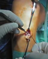 8 Anatomische Doppelbündelrekonstruktion des vorderen Kreuzbandes Operationstechnik 1 2 Die mit einem sterilen Hautmarkierungsstift angezeichneten Inzisionslinien zur Anlage der arthroskopischen