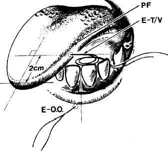 2 Muskelpartien: Transversus verticalis: verschmälern der Zunge bei Anheben,