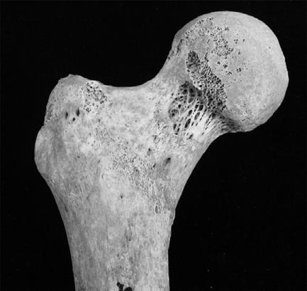 Eine weitere Ursache könnte der Druck sein, den der M. iliopsoas bei einer Kontraktion auf diese Knochenstelle ausübt. Abbildung 6: Poiriers Facie mit Schweregrad 6 (Barbing: Grab 1293). 3.6. Statistische Methoden 3.