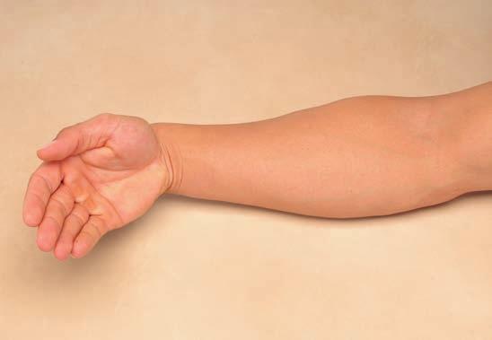 Handgelenksmuskulatur volar radial ulnar dorsal Funktion Der M. flexor carpi ulnaris beugt in den Handgelenken oder bewirkt, je nach Synergisten, eine Ulnarabduktion.
