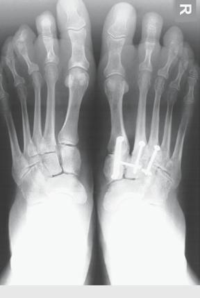 Diastase zwischen MT-I- und MT-II-Basis (Pfeile), b d nach Arthrodese der medialen Fußsäule durch Ausräumung des Restknorpels und