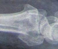 Schraubenkollisionen Unfallbild (seitliche Röntgenaufnahme der Fraktur) einer 73-jährigen Patientin Intraoperative Aufnahme nach dem