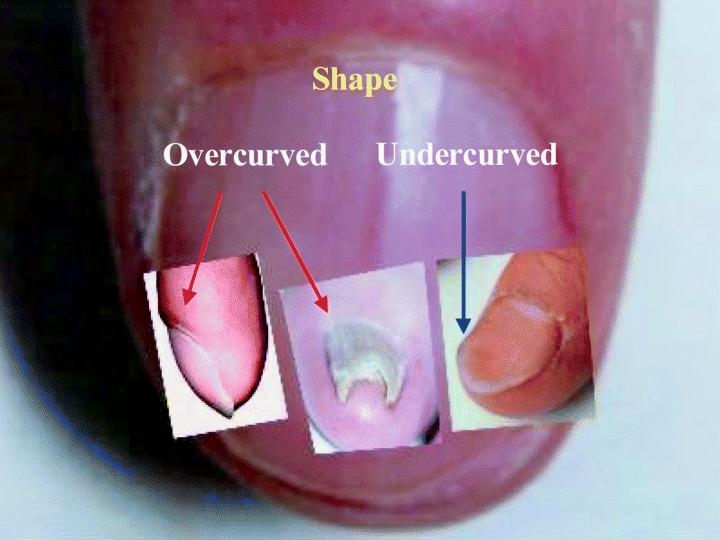 Nagelbett Ausgedehnte Nagelbettschädigung kann zu Veränderungen der Nagelplatten- Form führen: longitudinal