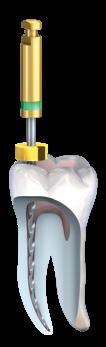 Gleichzeitig sind auch die Erfolgsprognosen endodontischer Behandlungen aufgrund neuer Therapieformen gestiegen.