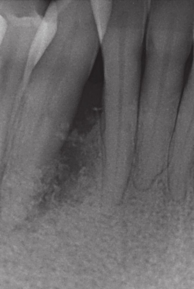 1: Ausgangssituation nach parodontaler Vorbehandlung und Versuch eines Gewebeaufbaus an Zahn 43 mit deutlich sichtbarem Weichgewebedefekt und Sekretabfluss. Abb.