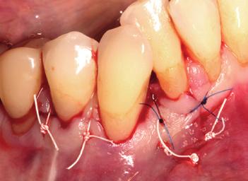 Radiologisch waren sowohl das ausgeprägte Hartgewebedefizit sowie einige nicht integrierte KEM-Partikel im mesialen Aspekt von Zahn 43 sichtbar (Abb. 2).