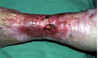 Infektionen Nekrotisierende Haut- und