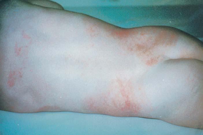 aureus-stammes aus Nasenabstrich oder Rachen, Toxingen-Nachweis (Speziallaboratorien) Therapie systemische anti-s.