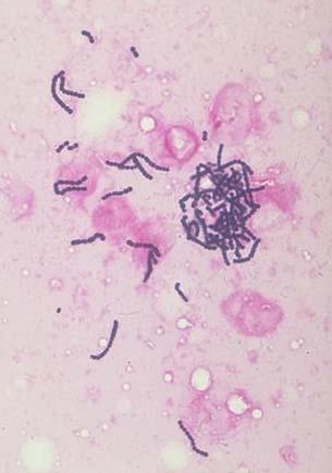 Streptococcus agalactiae (B-Streptokokken) Meningitis und Sepsis bei Neugeborenen Neugeborene