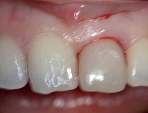 Fachbeitrag Sofortimplantation im sensiblen Frontzahnbereich Im Umkehrschluss denken Endodontische und parodontale Probleme sowie endodontische Komplikationen stellen den Behandler oft vor die