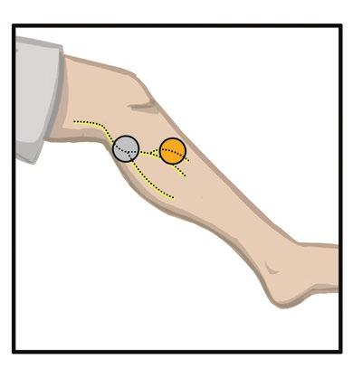 7. Bitten Sie den Patienten, Platz zu nehmen und das Bein auszustrecken, sodass es zwischen 15 und 20 Grad gebeugt ist. (Der Patient sollte sich während der Anpassung möglichst wenig bewegen.