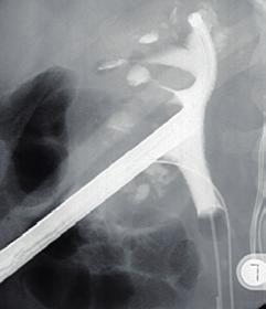 Röntgenbild mit dem in die Niere eingebrachten Endoskop Schematische