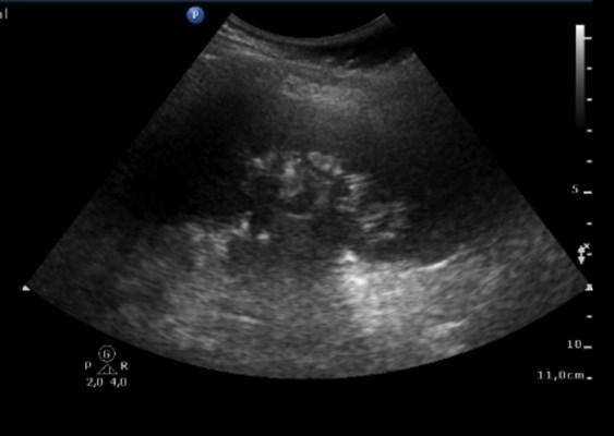 18 Ultraschallbild der linken Niere Niere Abb.