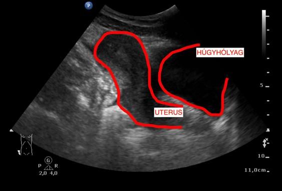 von Harnblase und Zervix Blase Uterus Abb.