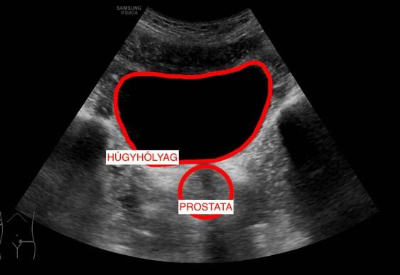 von Harnblase und Uterus Blase Prostata Abb.
