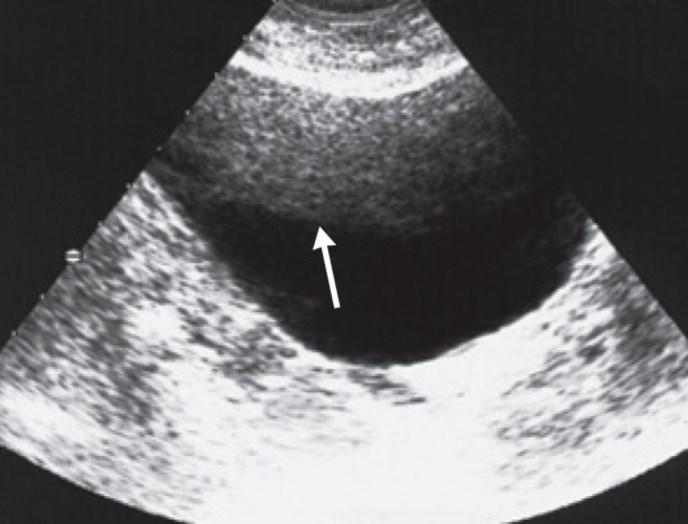 Abb. 6 Rauschen im Ultraschallbild (Pfeil) Abb.