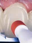 . A usgangssituation: Verfärbte Zähne, ausgedehnte Karies, Fehlstellung, falsche