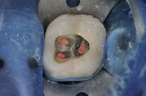 Bulkfüll-Komposits haben die Restaurative Zahnheilkunde spürbar bereichert.