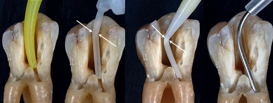 Colibri im anterioren Bereich mit Zementierung und Stiftaufbau Die Verwendung des individuell an die anatomische Form der Wurzel angepassten Mikroinstrumentariums stellt einen weiteren Erfolgsfaktor