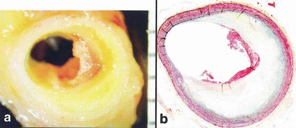 Plaque erosion: typische Manifestation der Koronaropathie bei jüngeren Frauen C.