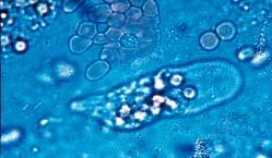 Abb. 1 Blutig muköser Durchfall eines Patienten mit Shigellose Abb. 2 Mikroskopische Aufnahme von Entamoeba histolytica Tab.