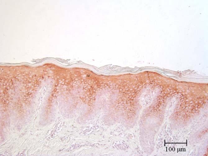 Auch die Anzahl MIB1- positiver Zellen pro mm Basalmembran war im Vergleich zu normaler Haut signifikant erhöht (M=62,4 bei LR vs. 36,6 bei GH, p=,46).