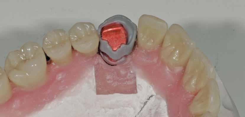 Die Cover-Denture-Prothese nach wie vor eine klassische Versorgung Teil 2 Der hier von Axel Mühlhäuser vorgestellte Patient war, wie im ersten Teil des Beitrags * ersichtlich, mit einer alten