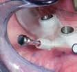 Die Implantologie ist heute aus der modernen Zahnheilkunde nicht mehr wegzudenken. Sie erweitert das prothetische Behandlungsspektrum und bietet neue Alternativen für das Therapiekonzept.