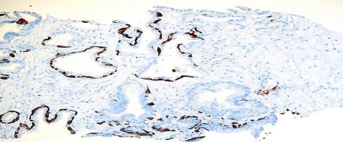 Subtotaler Verlust der Basalzellschicht HGPIN haben immunhistochemisch noch Basalzellen, invasiv wachsende Prostatakarzinome dagegen nicht HGPIN mit fast