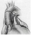 Das Reimplantationsverfahren nach David: Die Aortenwurzel wird unter Mitnahme der Aortensinus exzidiert und der Klappenhalteapparat wird ebenso wie die Koronargefäße in die Dacron-Prothese