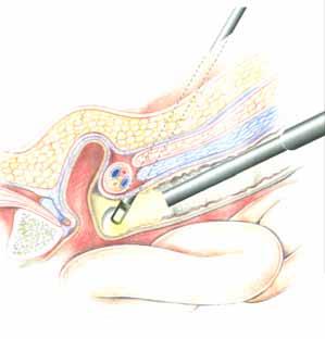 TEP Totale Extraperitoneale Technik: Die laparoskopische
