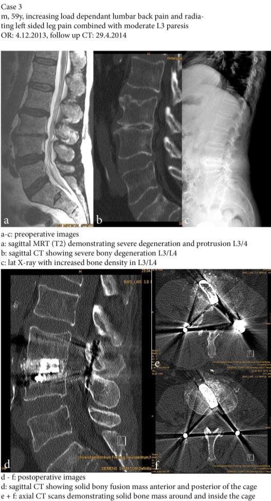 CASE REPORT 3 Functional X-rays showed mobility of the spondylolisthesis. Full spine X-ray showed no signs of severe sagital imbalance.