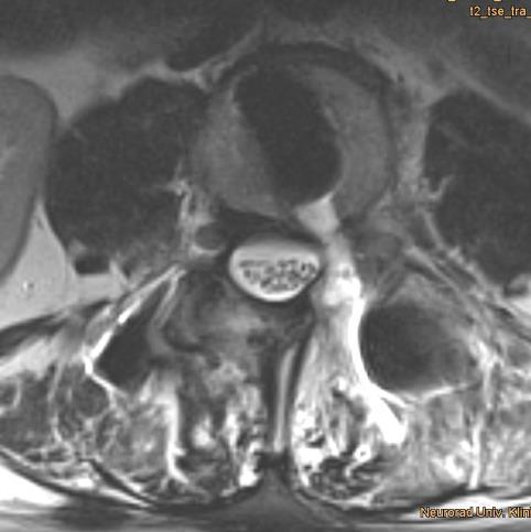 Postoperative sagital MRI demonstrating distraction and reduction of the L3 / 4 levels.