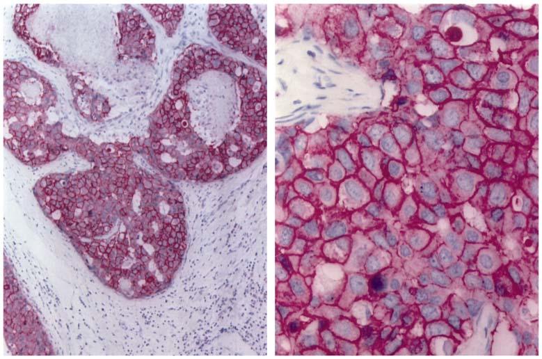 5a: Gering positiver Fall (10% der Tumorzellen weisen klare Membranfärbung für HER-2/neu auf).