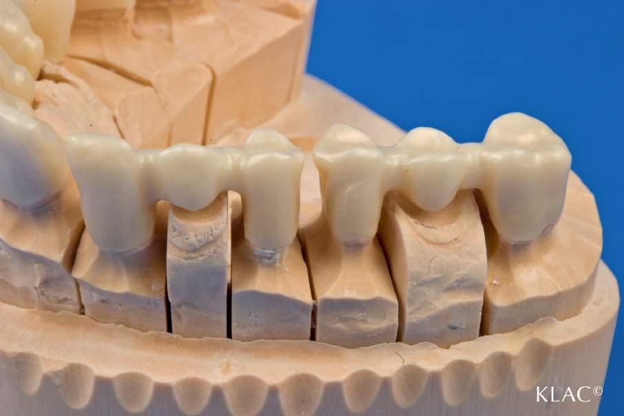 Abb. 11: Implantatgetragene ZrO 2 -Brückengerüste mit stabilen Konnektoren. Die Höckerunterstützung senkt das Risiko einer Verblendfraktur. Fraktur ausgeschlossen werden.
