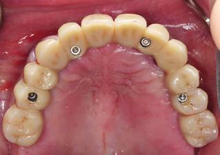 Durch die semipermanente oder vertikal verschraubte Fixierung lassen sich diese Arbeiten leicht für eine professionelle Zahnreinigung abnehmen oder im Bedarfsfall in eine abnehmbare Versorgung