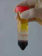 Ablauf des Lymphozytentransformationstests Gewinnung von 10 20 ml CPDA-Blut
