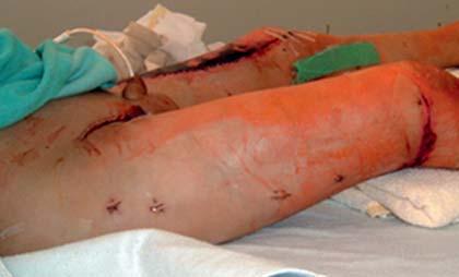 Abb. 6 Klinisches Verlaufsbild des verletzten Jungen. Die Wunde in der Leiste ist abgeheilt, die Nekrosen am linken Oberschenkel haben sich demarkiert.