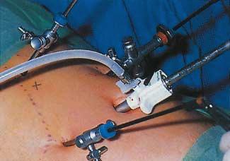 1.3.3 Enteroskopie, Doppelballon-Enteroskopie, Kapselendoskopie Die endoskopische Darstellung des Dçnndarms ist schwierig, da er weit von den Kærperæffnungen entfernt und sehr lang ist.