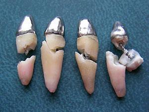 Zahn Hartgewebe Prevention Wurzelkanal Vorbereitung 1-2 mm großer als