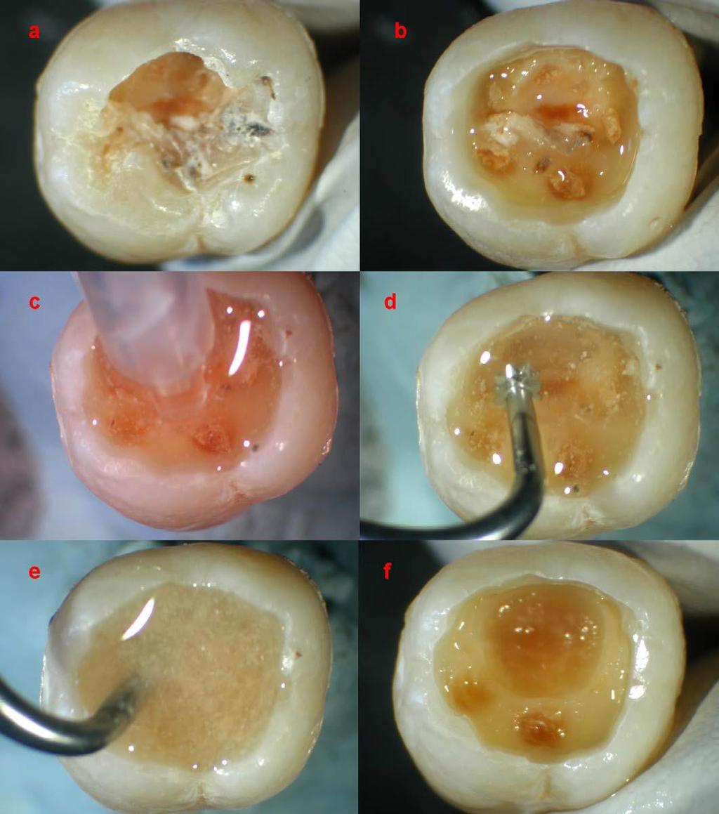 Chemische-mechanische Karies-Entfernung CarisolvTM gel. (a) The original occlusally cavitated carious lesion in a mandibular molar.