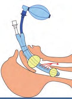 Atemwegsmanagement in der Intensivmedizin 31 Instrumente mit ösophagealem und oropharyngealem Cuff Combitube Der ösophagotracheale Doppellumentubus (Combitube) besteht aus zwei Lumina.