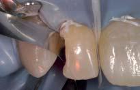 83 und 84 Distal dichtet bei der palatinalen Kompositschicht an Zahn