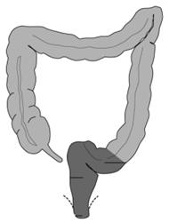 resektion ohne Sphinktererhaltung Falls der äussere Analschliessmuskel befallen ist: abdomino-perineale Amputation mit künstlichem Anus auf der linken Seite C2.