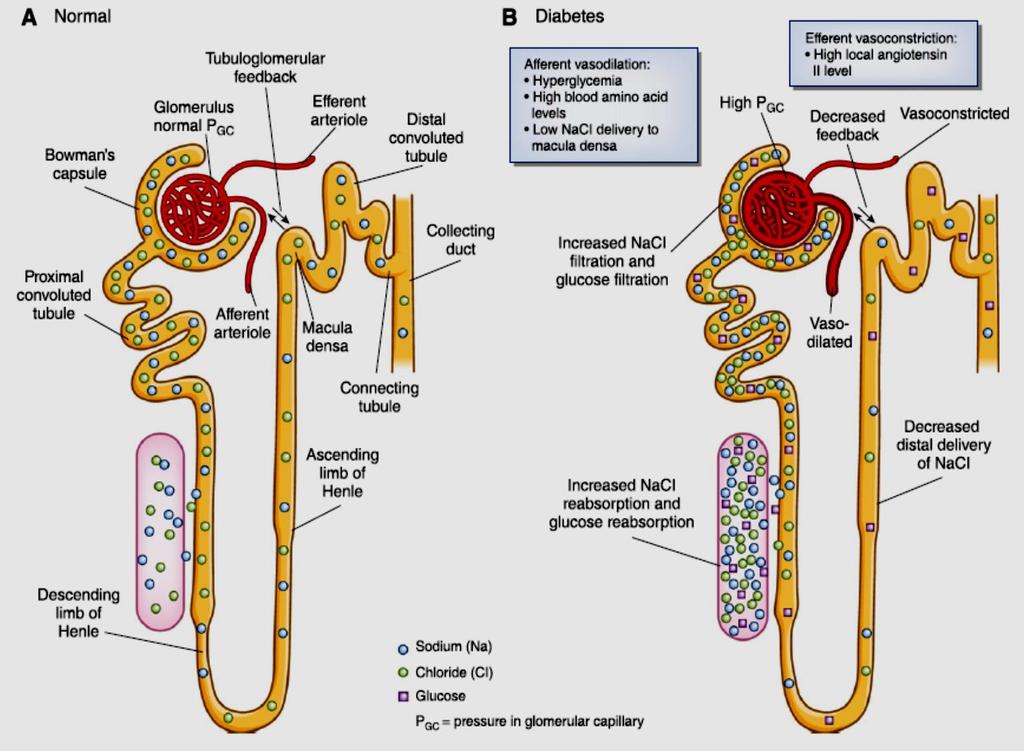 Normal and diabetic nephron with altered renal hemodynamics Fig.