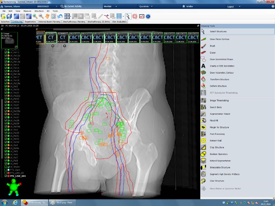 PaNerns of failure ager radical prostatectomy in prostate cancer implica(ons for radia(on therapy planning ager 68 Ga- PSMA- PET imaging Studie zur Erkennung von Rezidivmustern nach En^ernung der