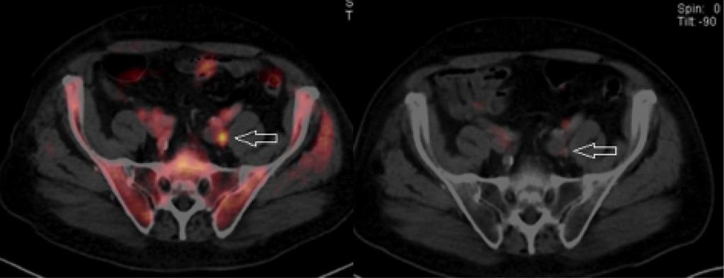 Integra(on of 68Ga- PSMA- PET imaging in planning of primary defini(ve radiotherapy in prostate cancer 68 Ga- PSMA- PET Bildgebung hat einen großen Einfluss auf die Stadieneinteilung und somit auch