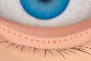 Krankheit verstehen Wie Trockene Augen entstehen Auf den ersten Blick scheint der Grund für Trockene Augen klar: eine zu geringe Tränenproduktion.